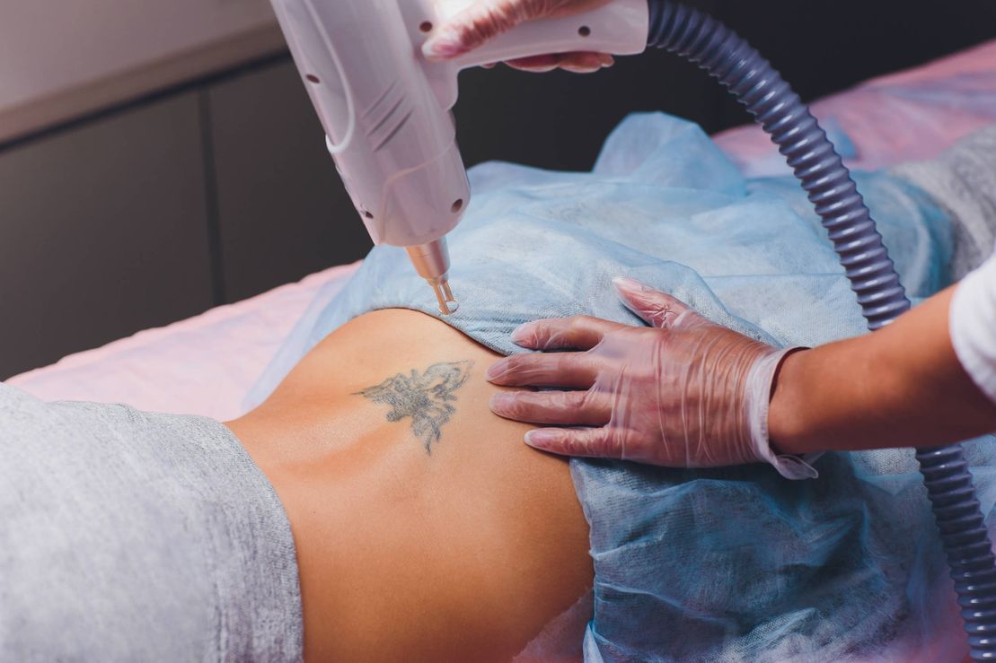 Tattoo Removal Fargo  Catalyst Clinical Spa  Schedule Consult